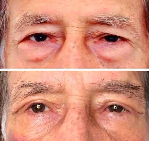 Caneta Lifting Instantânea - Trend+